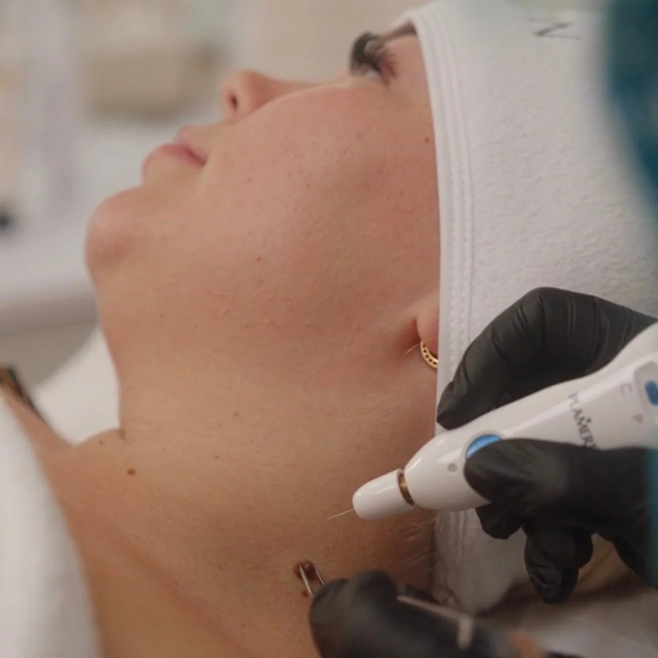 Plasma Pen-behandling mot skin tags, Salong Belle Jönköping